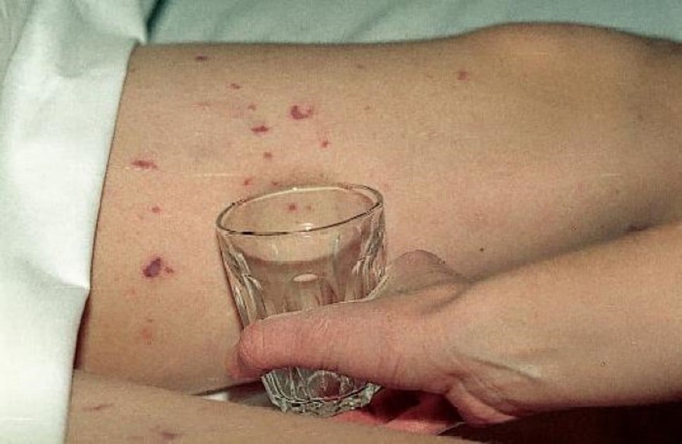 Personer med meningokokksykdom får av og til en bestemt type utslett. Det skyldes bitte små blødninger (petekkier) i huden som ikke går bort når du trykker på dem, slik som her hvor det trykkes et glass mot huden og utslettet. Foto: Petter Brandtzæg, Ullevål meningokokker